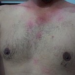 I have had severe urticaria since May . It is aggravated by heat , eating spicy foods , fried foods and non-vegetarian food items.