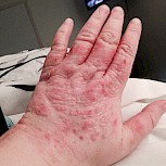 Having chronic urticaria is awful, I would never wish this for anyone not even my enemy. Xolair has saved my way of life and has helped me enjoy life again. I have attached a photo of my hands before they are hive free as of today because of xolair!